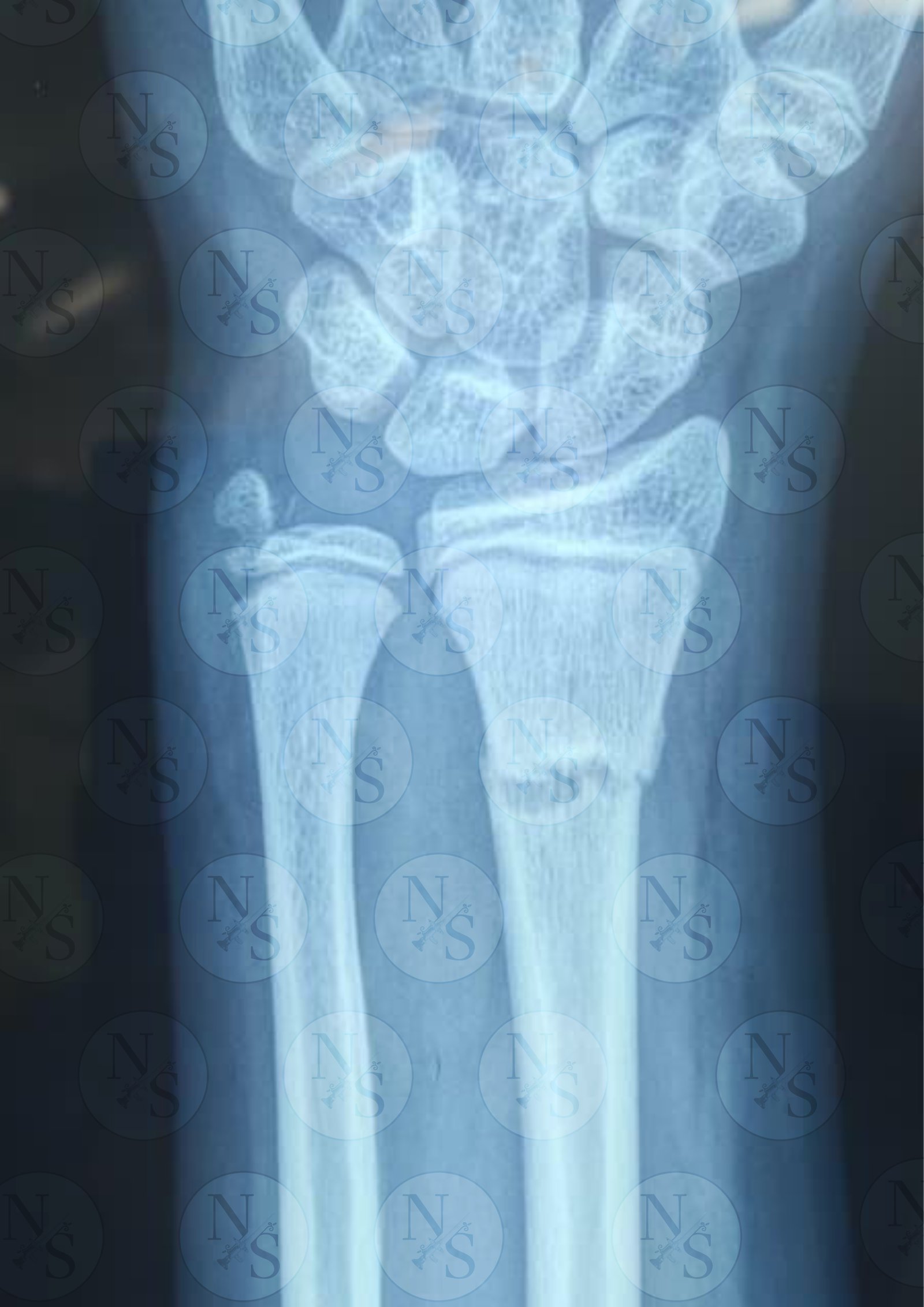 Radiografia frontal antes de fijacion percutanea por fractura de radio en paciente escolar