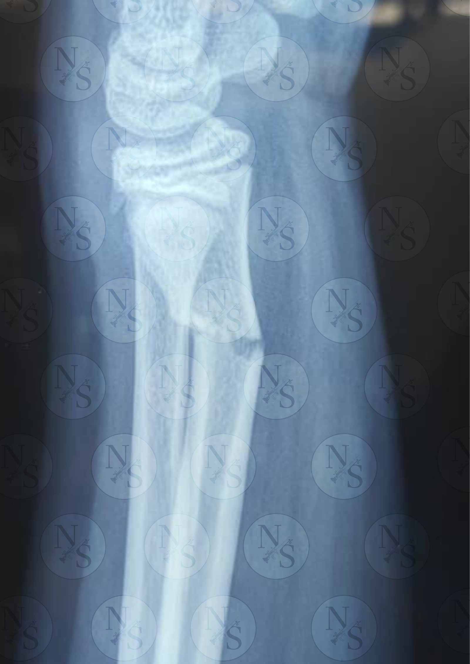 Radiografia lateral antes de fijacion percutanea por fractura de radio en paciente escolar