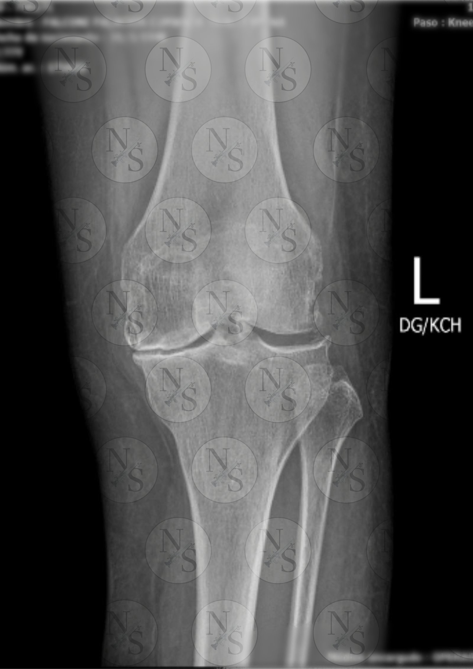 Radiografia frontal antes del tratamiento por artrosis severa de rodilla