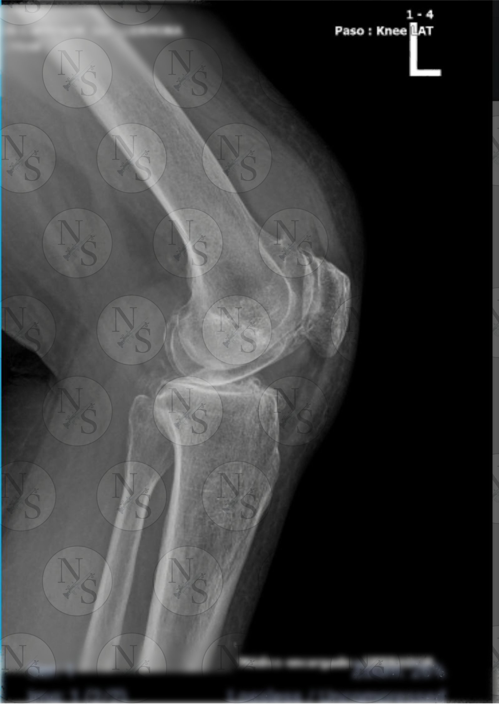 Radiografia lateral antes del tratamiento por artrosis severa de rodilla