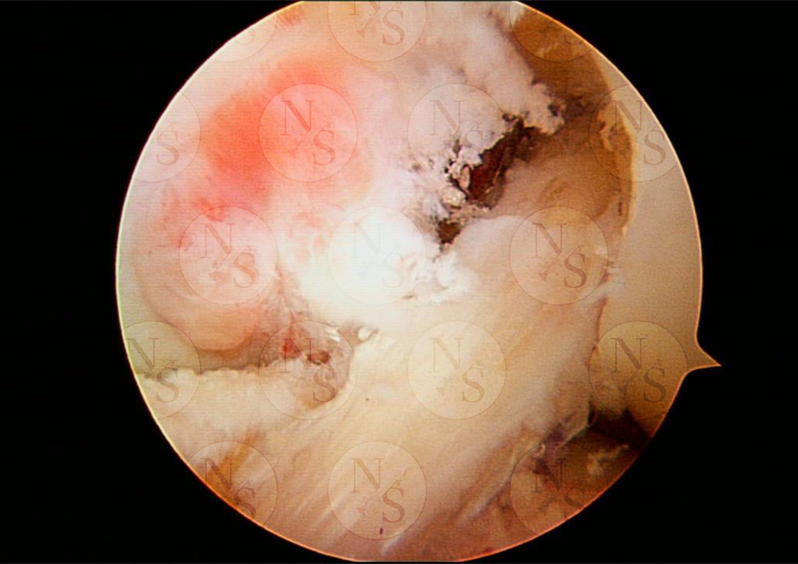Imagen artroscopica despues de reconstruccion de ligamento cruzado anterior