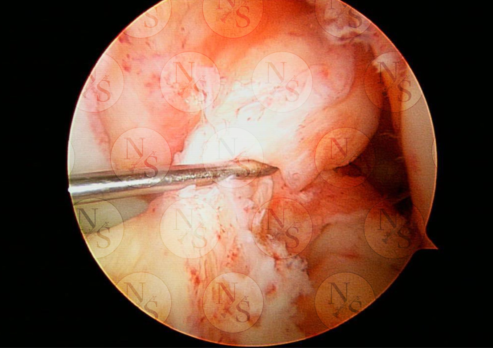 Imagen artroscopica antes de reconstruccion por ruptura completa de ligamento cruzado anterior