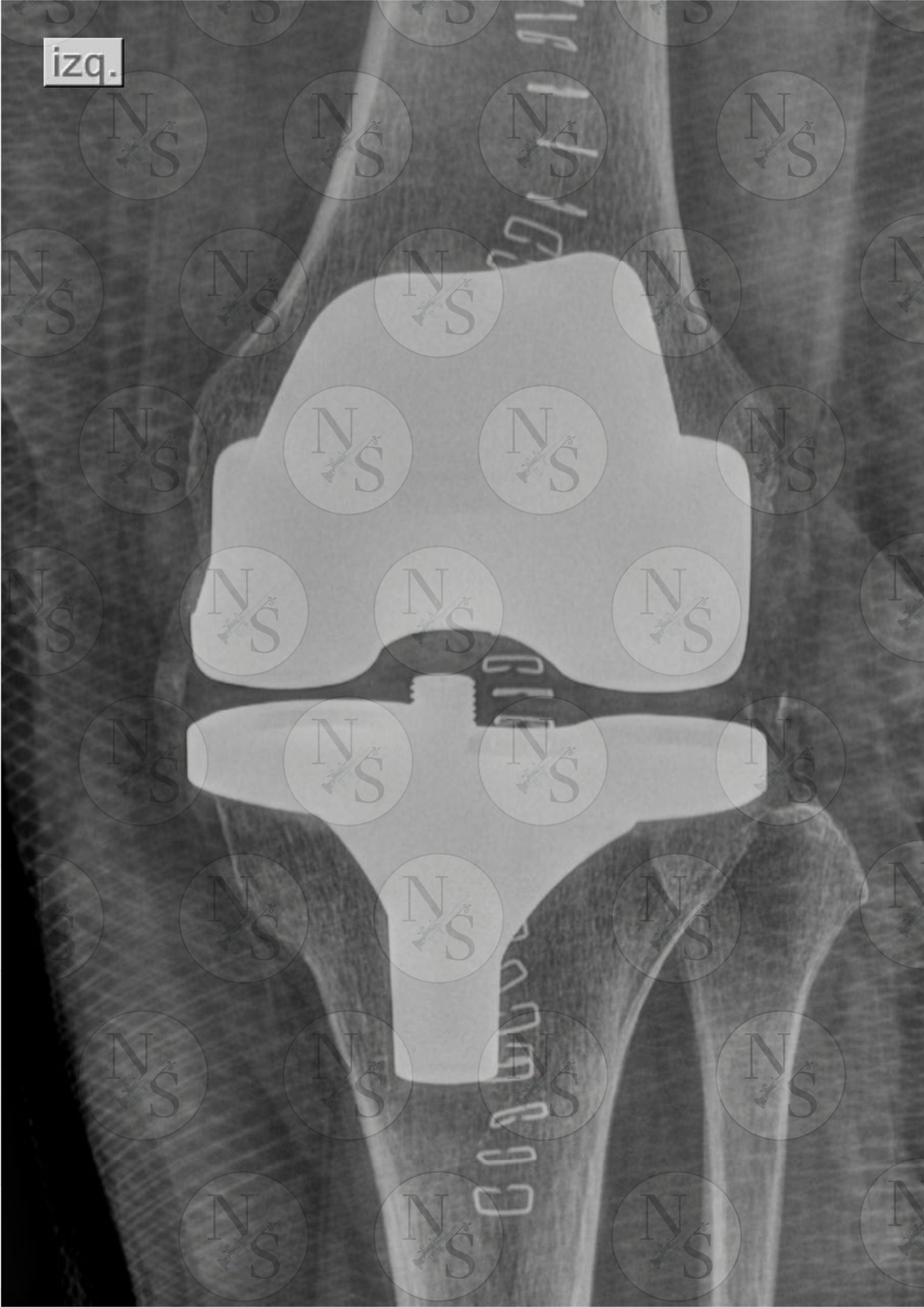 Radiografia frontal despues de colocacion de protesis total de rodilla