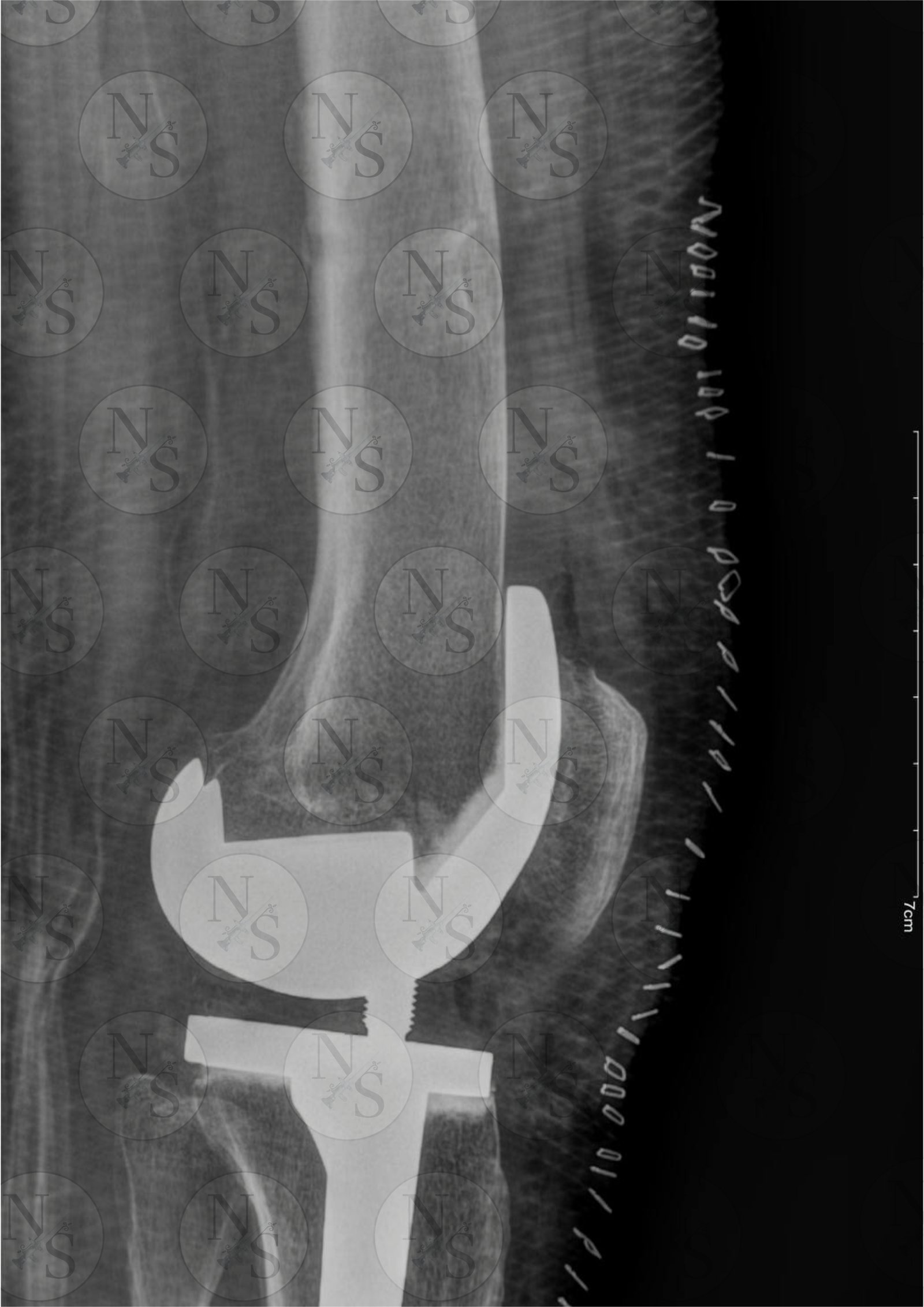 Radiografia lateral despues de colocacion de protesis total de rodilla