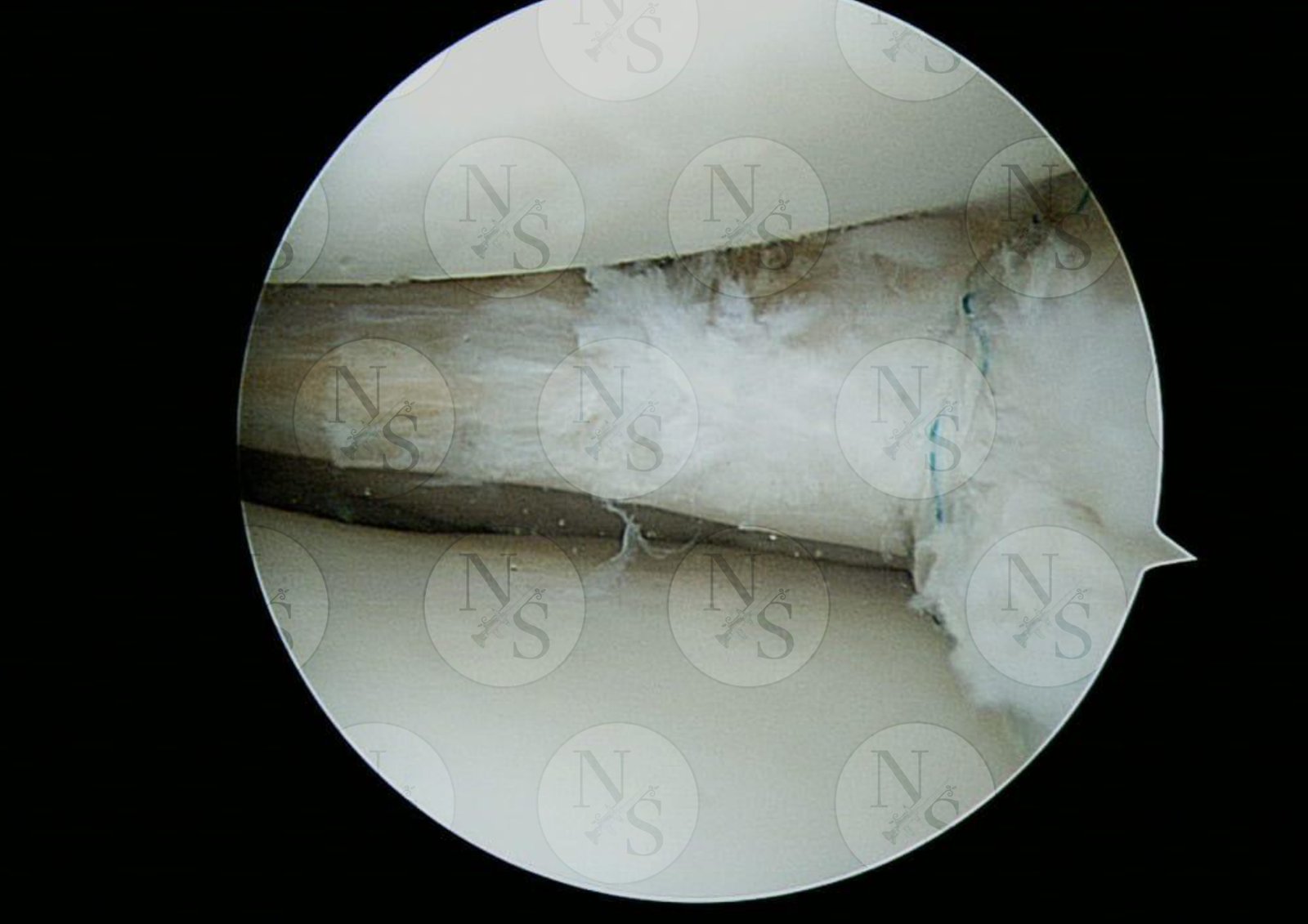 Imagen artroscopica despues del tratamiento por ruptura meniscal